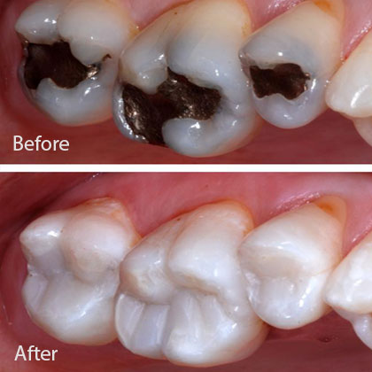 TOOTH COLORED RESTORATIONS – Dr Pratik Parmar's